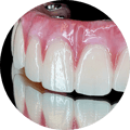 Denture (circle)